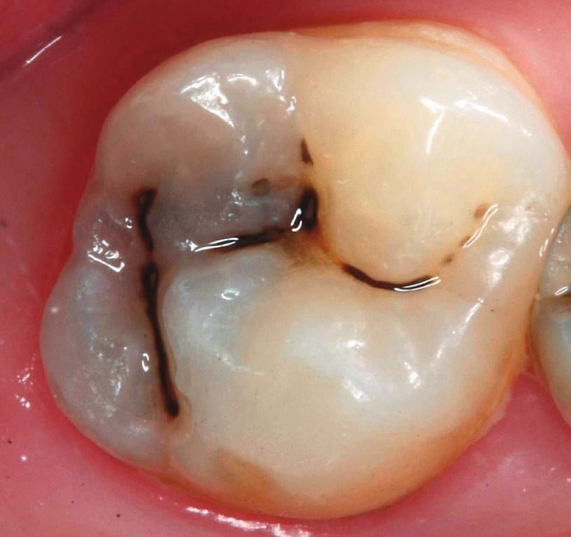Η τερηδόνα εντοπίζεται μέσα στην οδοντίνη (ιστολογικά αντιστοιχεί στο εξωτερικό τριτημόριο της οδοντίνης). Εικ. 1.14. Παρατήρηση της μασητικής επιφάνειας του γομφίου σε υγρές συνθήκες.