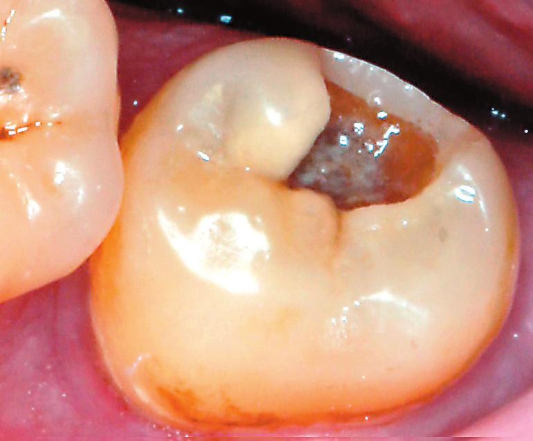 Σε οπτική παρατήρηση, χωρίς στέγνωμα του δοντιού, η οδοντίνη φαίνεται σκούρα. Μετά από στέγνωμα, είναι ορατή ανοικτή κοιλότητα με έκθεση της υποκείμενης οδοντίνης.