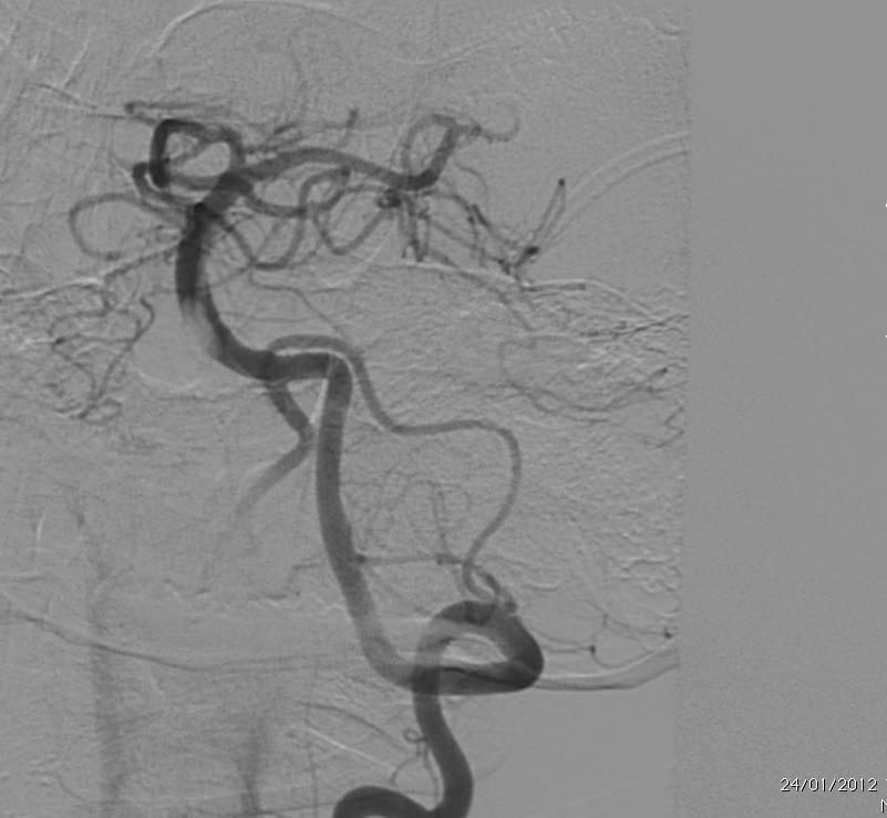 Post thrombectomy