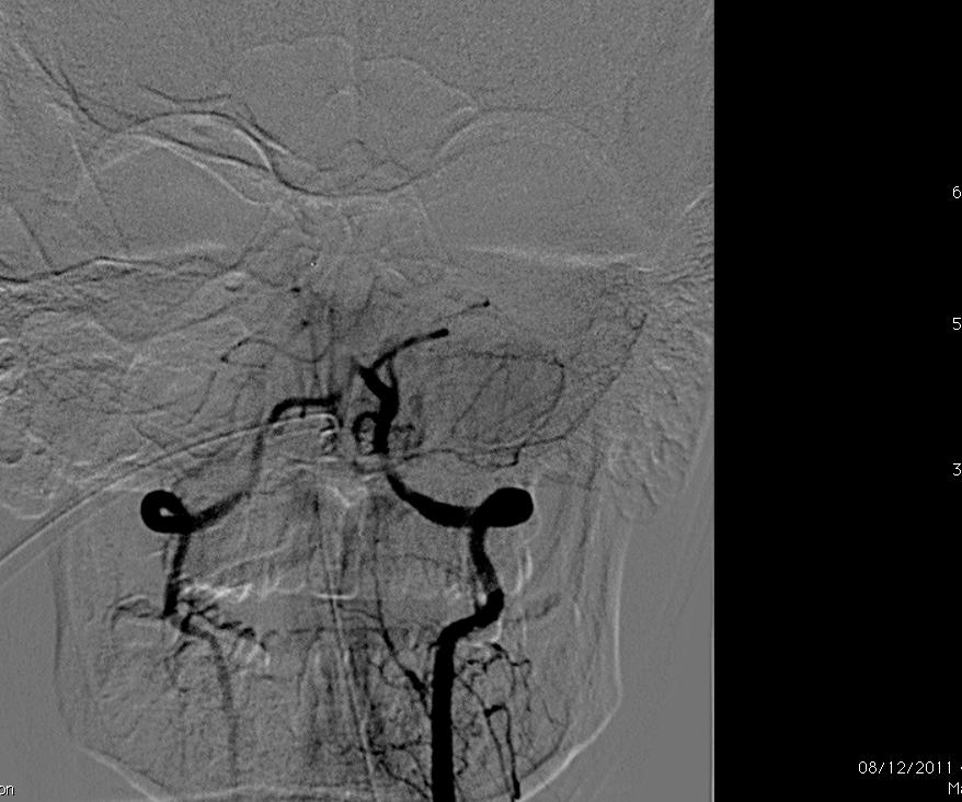 in syndrome VB JUNCTION