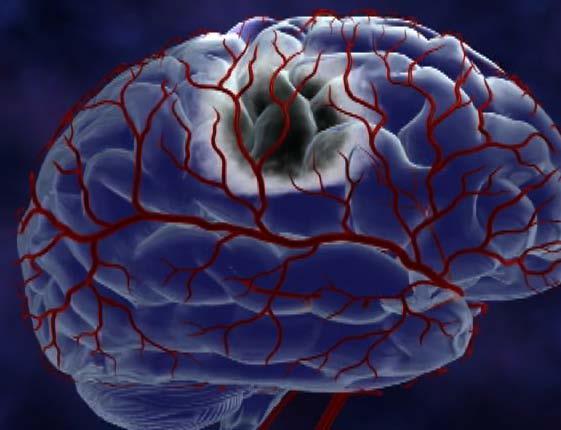 The Penumbra Surrounding this ischemic core is an area of reduced blood flow called the ischemic penumbra 1 The penumbra s cells receive