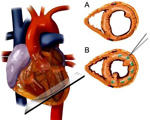 Anker et al, Eur Heart J 2015 Alginate-hydrogel (LoneStar Heart, Inc.