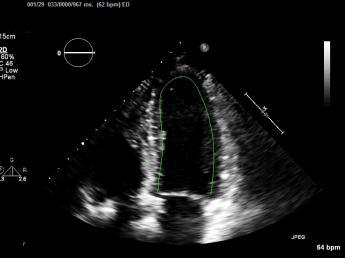 Βελτίωση: 11-1F4 mab (CAEL-101) Improves Left