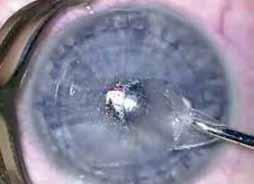 Refractive Flap for LASIK - LaserBlendedVision (LBV) Presbyopia Treatments - Corneal Inlay