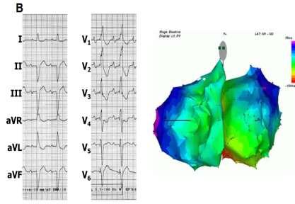 LBBB pattern RBBB