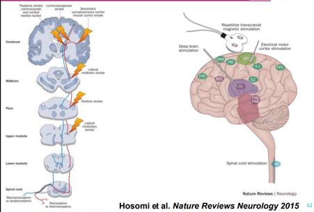 Post-stroke and Neuropathic pain Νευροπαθητικός πόνος Neuropathic pain definite analgesic effect of HF rtms of M1