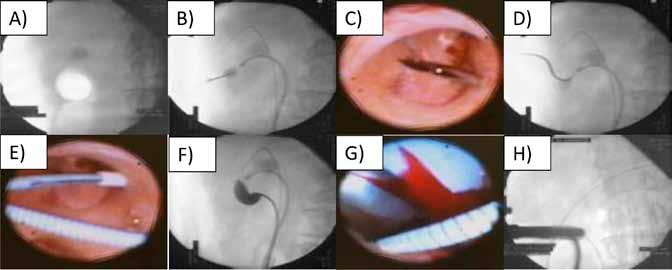 HELLENIC UROLOGY Figure 1. Endoscopic and Fluoroscopic images of the procedure. A) Demonstrates the renal calculi fluoroscopically, subsequently with the FURS in place.