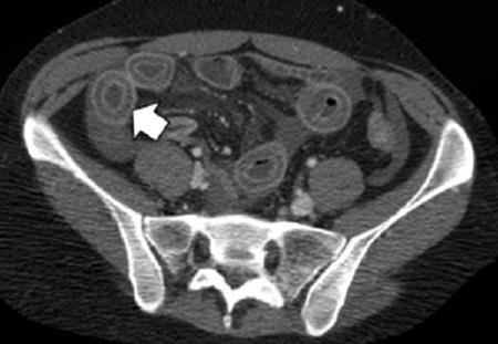 Εντερίτιδα του λύκου Απεικονιστικά ευρήματα CT κοιλιάς: εξέταση εκλογής ευρήματα φλεγμονής εντέρου, επιπλοκές;, άλλα αίτια; οίδημα τοιχώματος εντέρου (95%) παθολογική