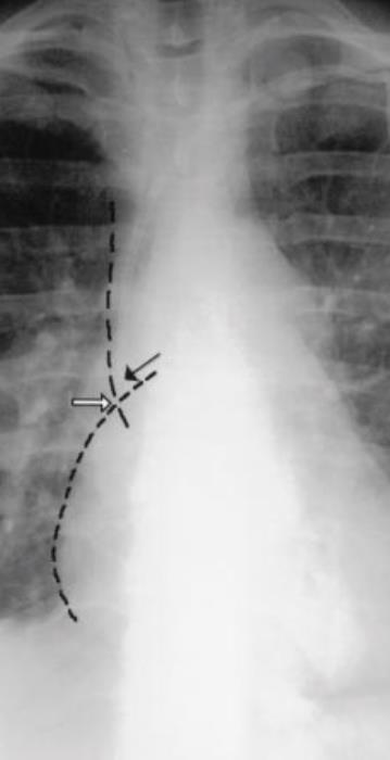 % Malfunction Θέση άκρου κεντρικού καθετήρα Catheter Tip Location above SVC/RA