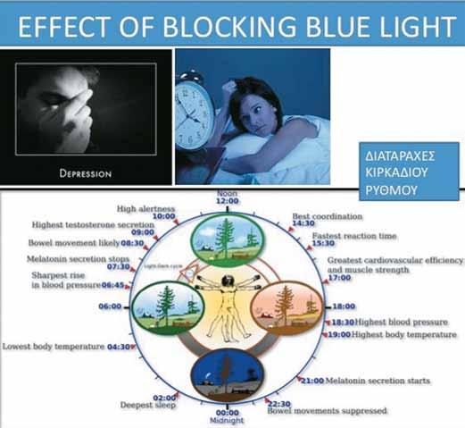 καταρράκτης Εικόνα 3. Διαταραχές από blue-blocking IOLs τεί τομή 12mm και μεγάλη καψουλόρηξη (7mm) και βεβαίως σταθερή ζίννειο ζώνη (Εικόνα 5).