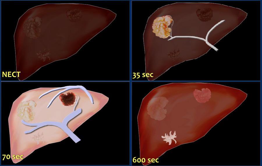 CT triple phase και MRI όλοι οι