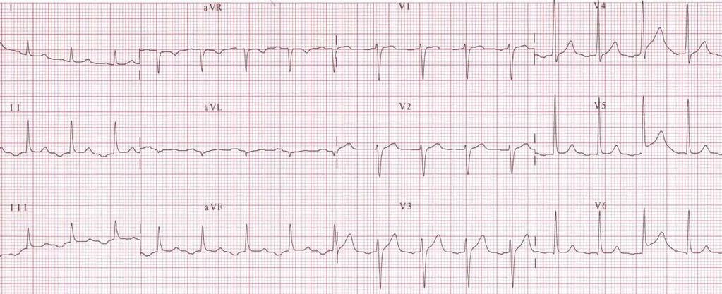 Focal Atrial