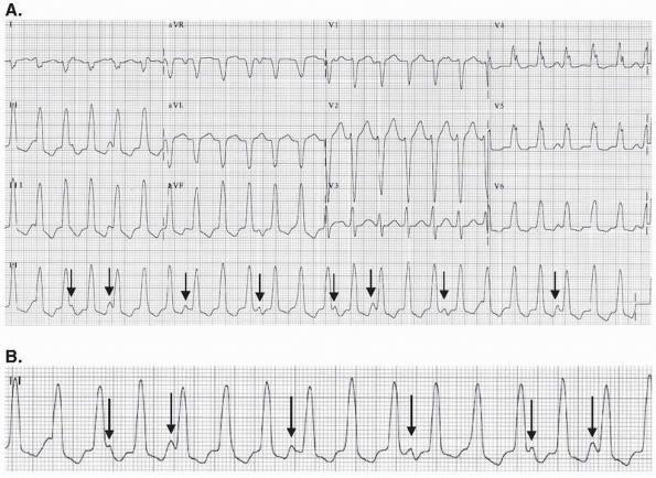 AV Dissociation atrial rate slower than