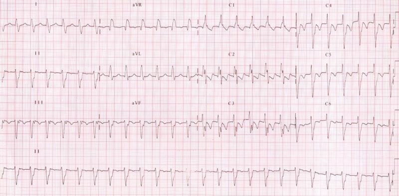 Fascicular