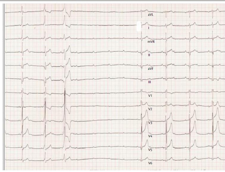 Adenosine injection (12mg bolus) was performed to