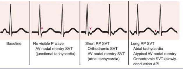 P wave