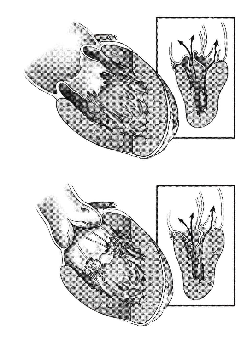 HOCM and mitral valve morphology Degenerative: thin leaflets with excessive mobility Restrictive chordae: single or multiple secondary chordae redtricting anterior leaflet