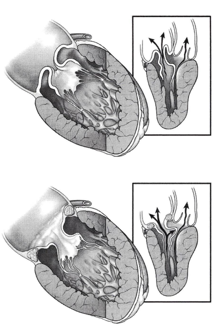 HOCM and mitral valve morphology Myxomatous with thickened redundant leaflets Restrictive leaflet: thickened leaflet often associated with annular
