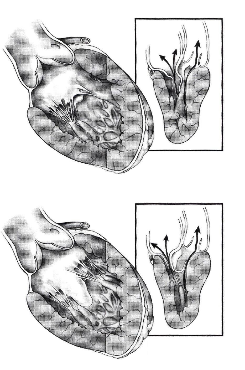 HOCM and mitral valve morphology Papillary muscle most common variant: large antero-medial
