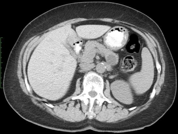 MRI-MRCP: