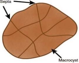 SCN SPN Ψευδοκύστη Acinar cystadenoma