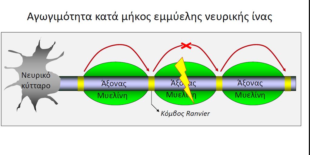 ΠΟΛΛΑΠΛΗ ΣΚΛΗΡΥΝΣΗ =σκλήρυνση κατά πλάκας Φλεγμονωδης και απολυελινωτική νόσος ΚΝΣ Αγνωστη αιτιολογία (αλληλεπίδραση γενετικών και