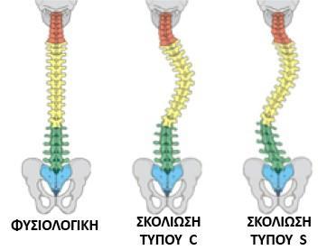 Εικόνα 1.4. αναπαράσταση ανατομίας σκολιώσεων τύπου C και τύπου S Πηγή: Βιοανάταξη - Τσικρικάς Βαλάντης Περεταίρω διαχωρισμό λαμβάνουν τα κυρτώματα και ανάλογα τη περιοχή που εμφανίζονται.