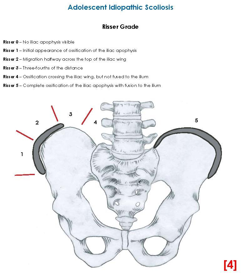 Εικόνα 1.10. αξιολόγηση πυέλου σε σκολίωση και εύρεση σημείου Risser που προκύπτει ανάλογα με την οστεοποίηση της λαγόνιας ακρολοφίας πηγή: radiologyarchives.com 1.5.1. Γενική επισκόπηση Αρχικά γίνεται μια πλήρη επισκόπηση του ασθενή από πρόσθια, οπίσθια και πλάγια άποψη.