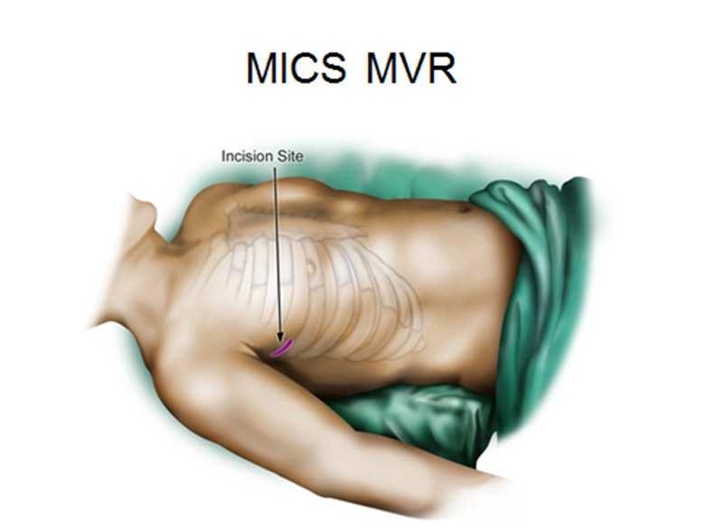Minimally invasive mitral valve surgery?