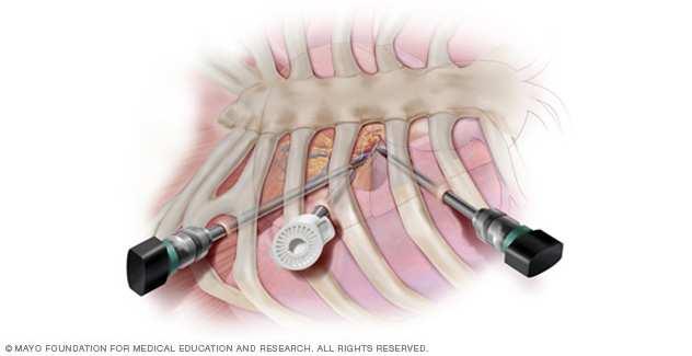 percutaneous superior vena cava/inferior vena