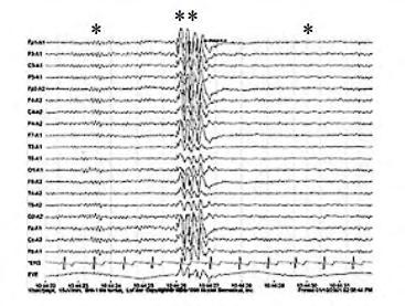 Εικόνα 4: Καταγραφή σε ένα ΗΕΓ φυσιολογικής (ο ασθενής είναι ξύπνιος και σε εγρήγορση) (*) και επιληπτικής (**) δραστηριότητας (επιληπτική κρίση). (Teiath.gr, 2017) 1.