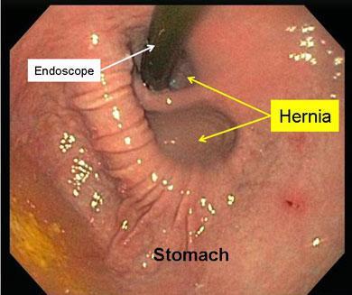 παραοισοφαγικού σκέλους της κήλης Ενδοσκόπηση Έλεγχος για
