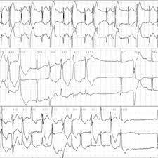 ATS Clinical signs: Usually symptoms by age 20 palpitations and/or syncope usually Periodic paresis: weakness that occurs on waking or following rest after exertion.