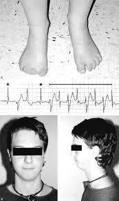 Potassium Levels: VT triggered by low or high potassium potassium supplement During exercise, rest