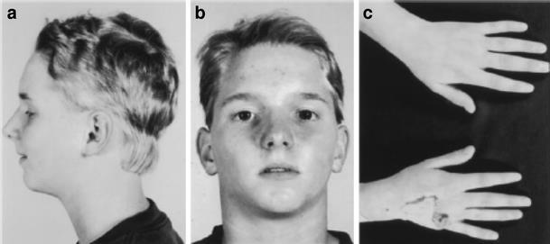 and chin curved or crooked fingers webbing cleft palate, and curvature of the spine Most small in