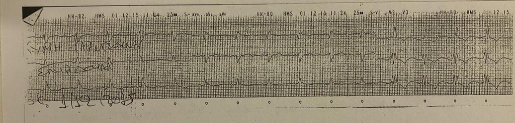 Triplex φυσιολογικό εργαστηριακά CORO: 90% LAD- PTCA με stent DDDR βηματοδότης λόγω επιμένουσας βραδυκαρδίας και παράτασης του QT- QTc εξόδου