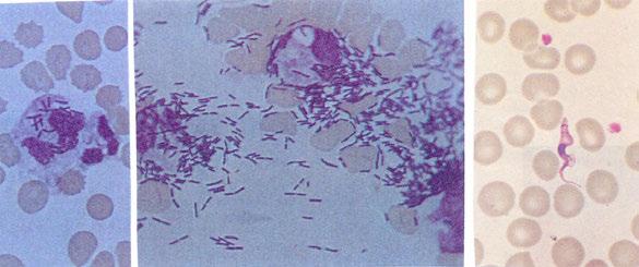 Α Φαγοκυτταρωθέντα, από κοκκιοκύτταρα,