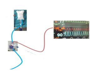 Ο αυλός του κεντρικού φλεβικού καθετήρα συνδέεται, μέσω ενός κυκλώματος που περιέχει διάλυμα N/S 0,9% (που βρίσκεται ομοίως της επεμβατικής μεθόδου καταγραφής της ΑΠ σε ασκό υπό πίεση 300mmHg) με