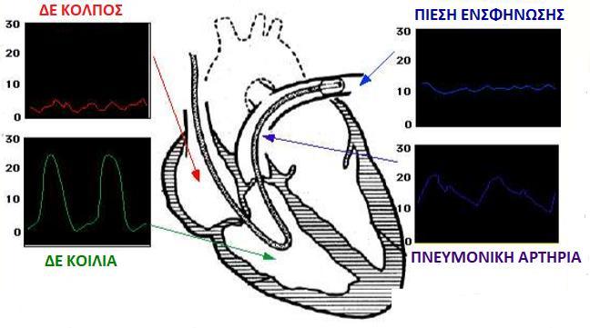 Δ. ΜΕΤΡΗΣΗ ΤΗΣ ΚΑΡΔΙΑΚΗΣ ΠΑΡΟΧΗΣ ΔΕΞΙΟΣ ΚΑΡΔΙΑΚΟΣ ΚΑΘΕΤΗΡΙΑΣΜΟΣ Όταν ο καθετήρας εισέλθει στο ΔΕ κόλπο έχουμε κυματομορφή κεντρικής φλεβικής πίεσης (CVP).