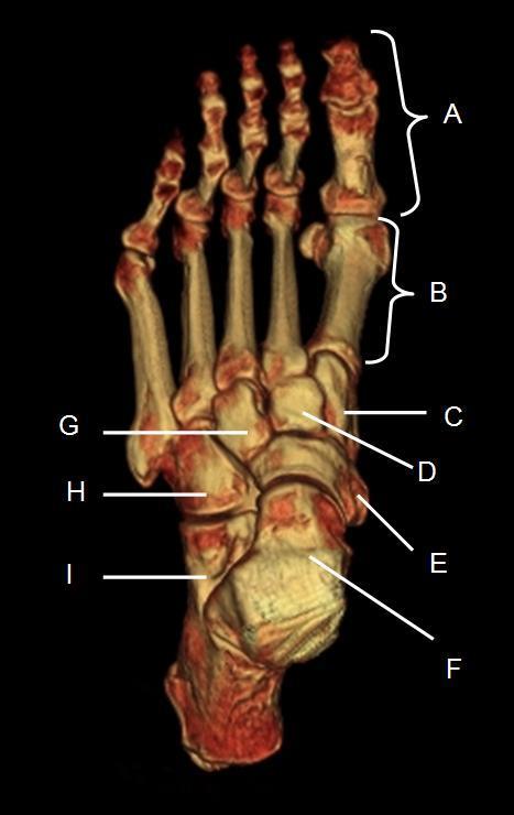 Ανατομία άκρου ποδός the phalanges (A) φάλαγγες, metatarsal row (B) μετατάρσια, medial cuneiform (C) έσω σφηνοειδές, intermediate cuneiform