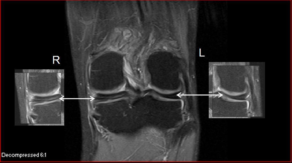 Ανατομία άρθρωσης γόνατος Ο δεξιός και αριστερός μηνίσκος προβάλλονται σε μεγέθυνση.