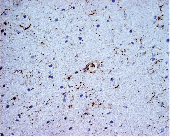 Enhanced ceramide expression