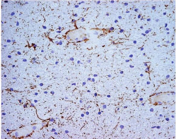 O N + Sphingomyelinase (ASM)