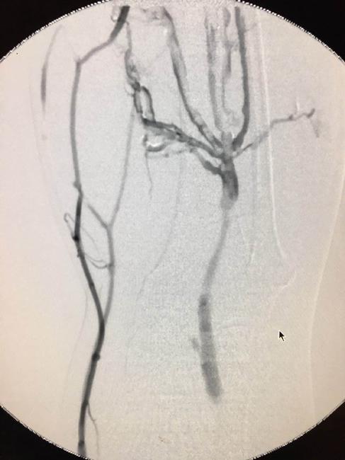 47 189 236 47 189 236 47 189 236 2.2 P<0.05 P>0.05 2 Tab.2 2 D- DVT Value of color Doppler ultrasound and plasma D-dimer alone and combined in the diagnosis of DVT 85.11%40 /47 96.83%183 /189 94.