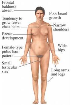 Φυλοσύνδετες χρωμοσωμιακές ανωμαλίες Klinefelter s syndrome (47,XXY; 46,XY/47, XXY mosaicism) -1:500-1:1000 αγόρια - Η πιο συχνή είναι το σύνδρομο Klinefelter (47,XXY) περίπου 10% των αζωοσπερμικών