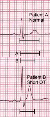 Overview Long QT Short QT