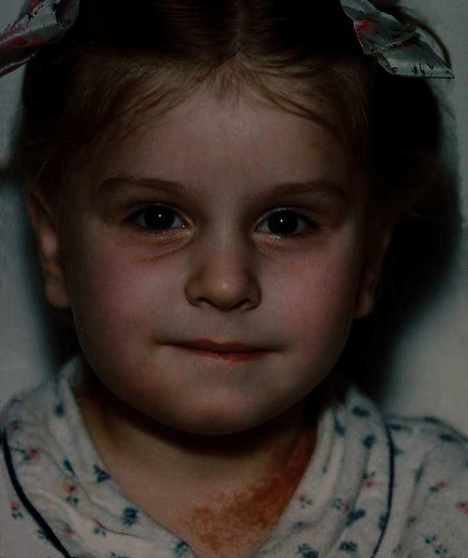 The infection spread leading to swelling that prevented