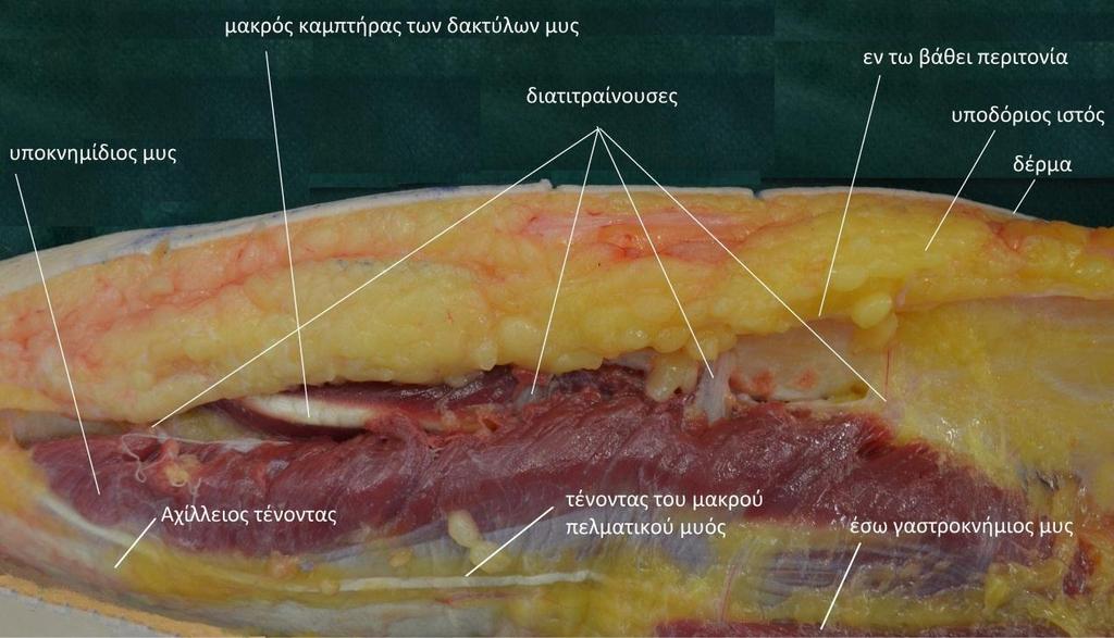 Η τομή πραγματοποιείται, κατά μήκος της οπίσθιας γραμμής, διαδοχικά, στο δέρμα, τον υποδόριο ιστό και την εν τω βάθει μυϊκή περιτονία, από το ύψος του έσω σφυρού έως τον έσω κνημιαίο κόνδυλο.