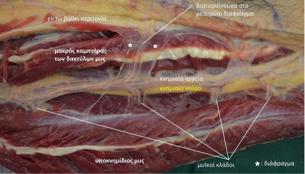 Πορεία Διατιτραινουσών Τύπος Διατιτραινουσών Το 77,4% (120/155) των διατιτραινουσών διέσχιζε το διάφραγμα μεταξύ του υποκνημίδιου μυός και του μακρού καμπτήρα των δακτύλων μυός (διάφραγμα V κατά