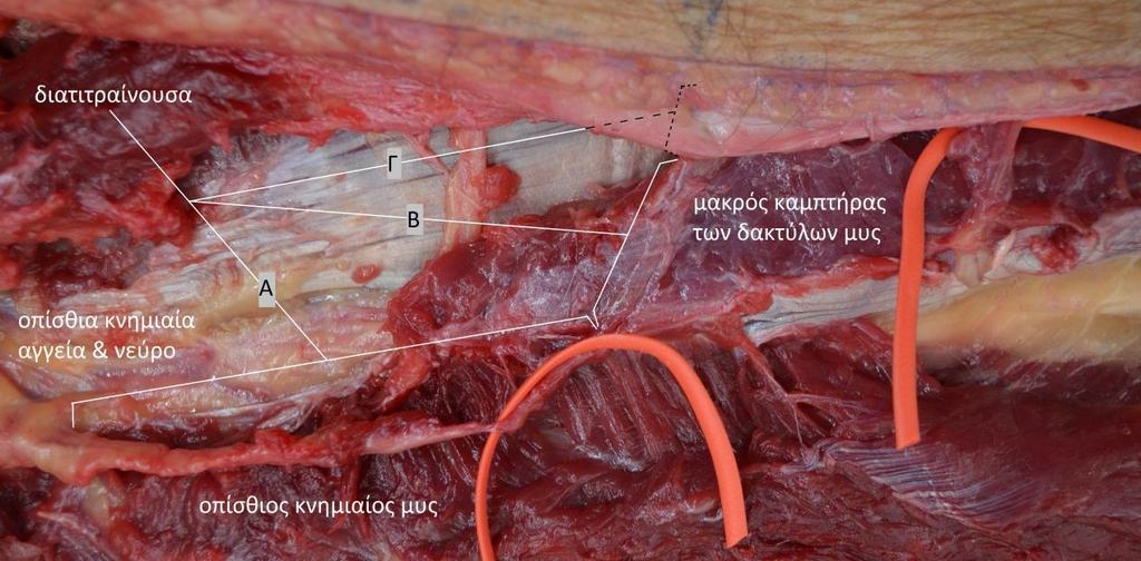 Εικόνα 51: Διατιτραίνουσα διαφραγματομυοδερματική, δια του οπίσθιου κνημιαίου μυός (Α), του